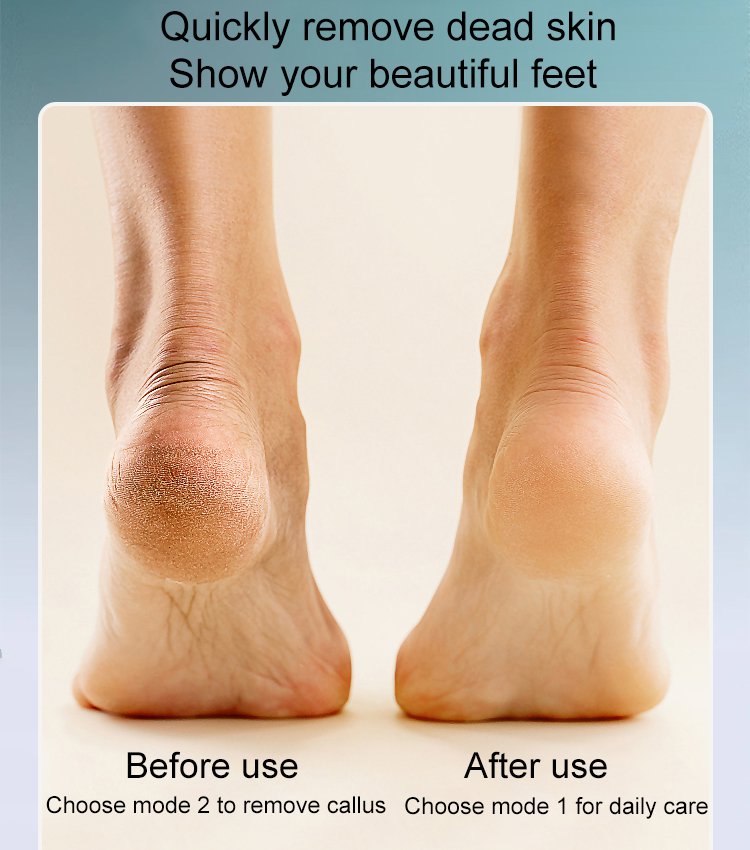 🔥Heißer Verkauf💕Wiederaufladbarer elektrischer Hühneraugenentferner