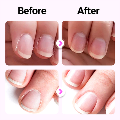 👍🧑‍⚕️Reparatur von Nagelschäden✨ „Duft + Maniküre + Schutz“ in EINEM tragbaren Nagelpflege-Stift💅